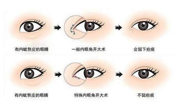 開內(nèi)眼角適合哪些人群?開內(nèi)眼角會留疤嗎?