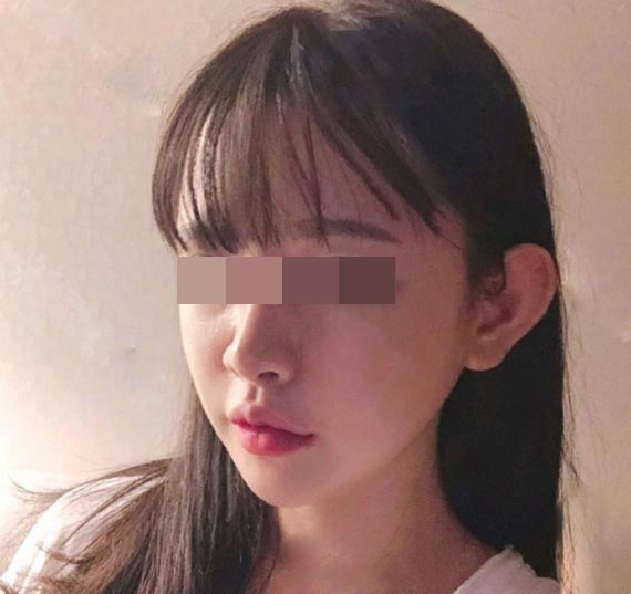 吳興中下頜角磨骨案例3