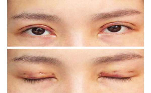 韓式三點雙眼皮是不是永久的?雙眼皮術后不對稱怎么辦?