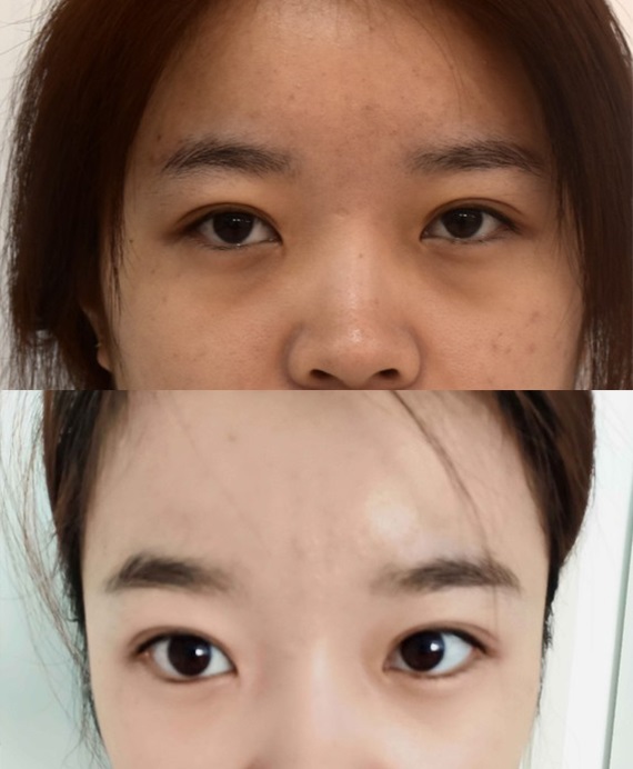 微創(chuàng)祛眼袋