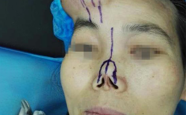 全鼻再造手術的方法有哪些?手術前要做什么準備