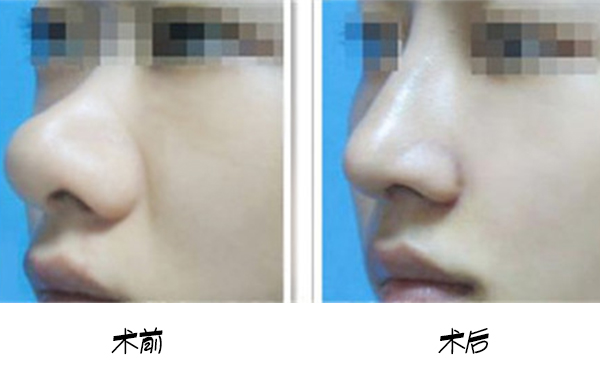 武漢美亞鼻頭肥大矯正術(shù)多少錢?網(wǎng)上查到的和醫(yī)院報價一樣嗎?