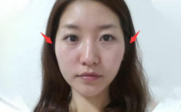 蘭州亞韓整形：顴骨突出做顴骨降低整形手術(shù)就對(duì)了