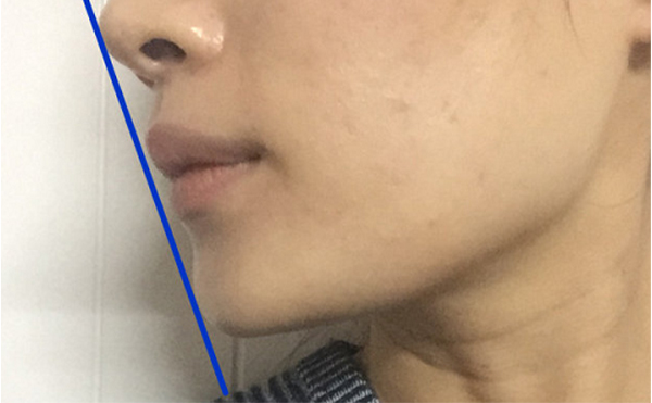 做假體墊下巴恢復(fù)后會(huì)被摸出來(lái)做過(guò)嗎？還能打玻尿酸嗎？