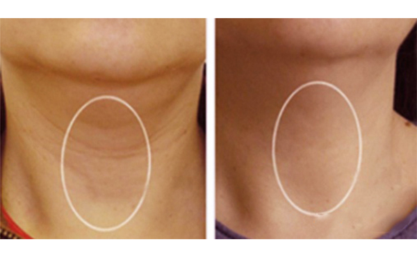 嗨體去頸紋能維持多久？