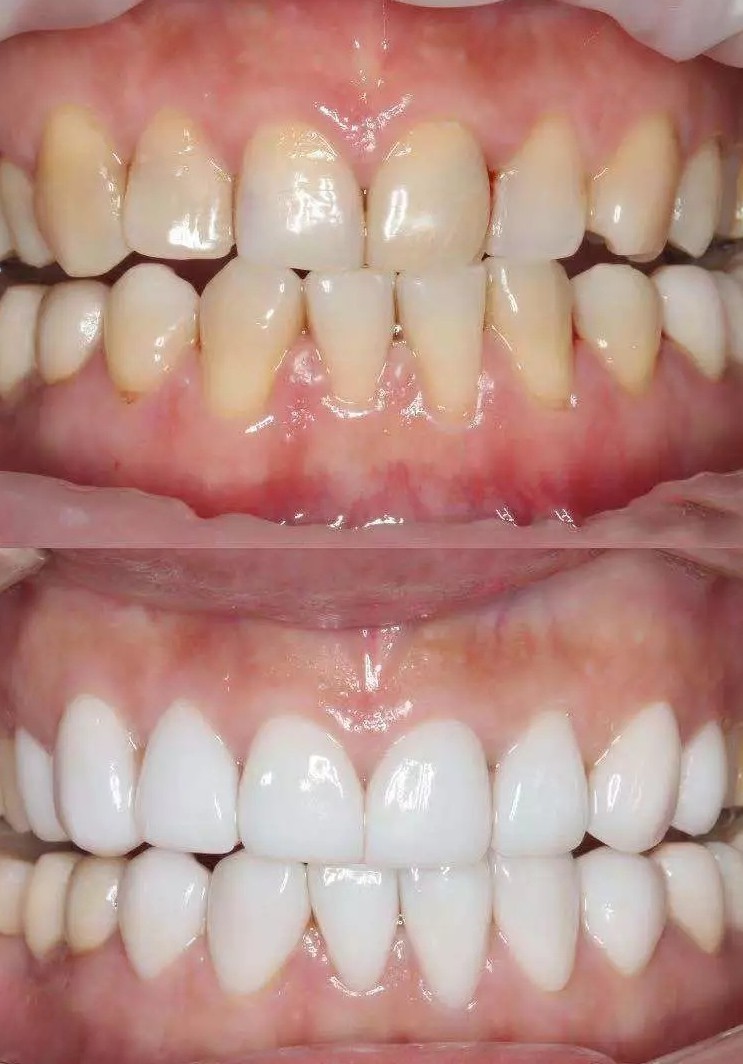 牙齒美白前后效果對比圖