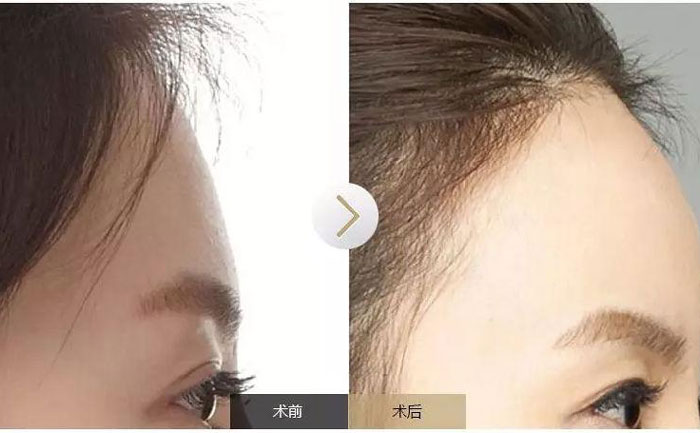 額頭填充術(shù)可以保持多久？