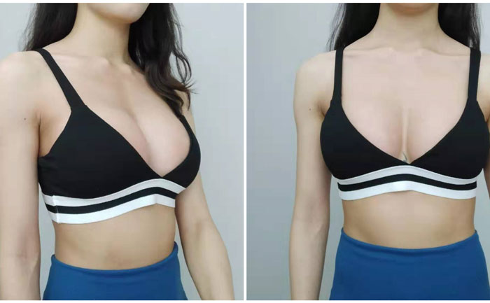 自體豐胸可以保持多久？自體脂肪豐胸真實效果