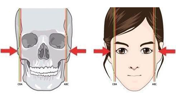 重慶五洲顴骨整形手術(shù)是怎么做的?具體有哪些步驟?