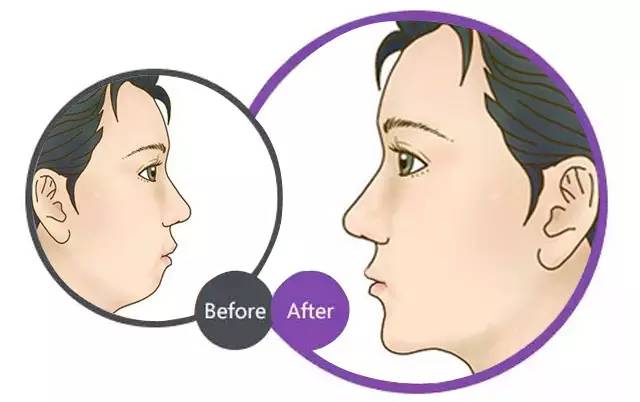 下巴突出是什么原因引起的？