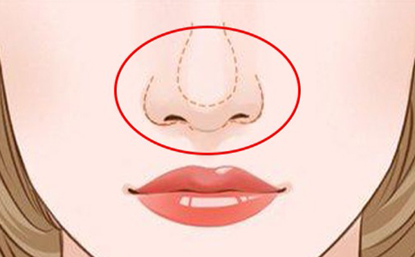 做鼻頭縮小有哪些方法?