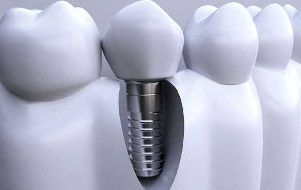 種植牙能使用多少年？