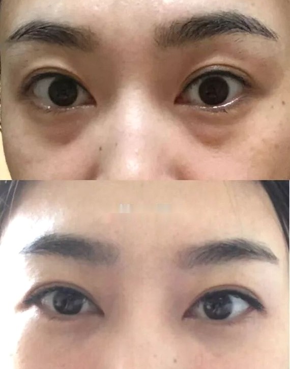 微創(chuàng)祛眼袋手術(shù)效果