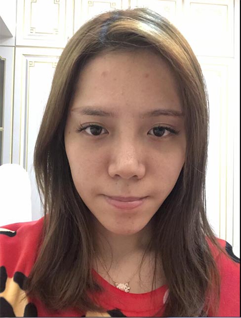 肋軟骨鼻綜合案例:術(shù)前效果