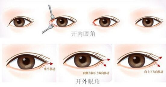 開(kāi)外眼角