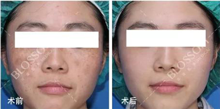 華韓醫(yī)療美容醫(yī)院祛斑案例對比