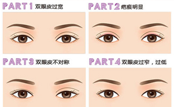 雙眼皮手術(shù)失敗如何修復(fù)呢?需要多長(zhǎng)時(shí)間?