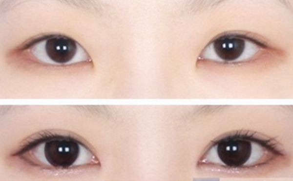 開眼角手術(shù)會(huì)不會(huì)留下疤痕?術(shù)后有什么注意事項(xiàng)?