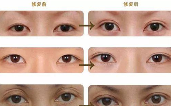 雙眼皮修復(fù)可靠嗎？什么時(shí)候做雙眼皮修復(fù)比較好？