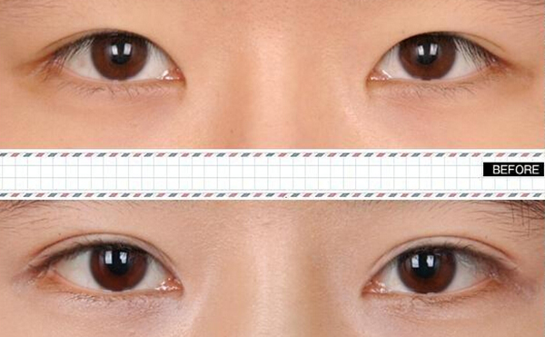 內雙怎么才能變成雙眼皮?效果好嗎?