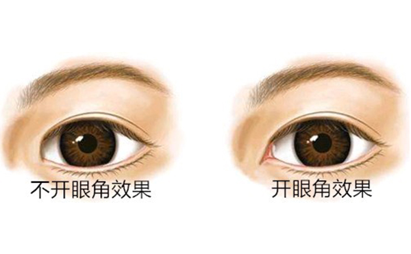 開內(nèi)眼角價格是多少?開內(nèi)眼角多久能恢復(fù)好?