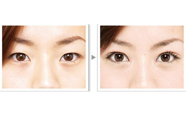 雙眼皮手術(shù)的種類及優(yōu)缺點是什么?術(shù)后怎么護理效果好?