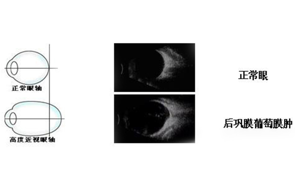 什么樣的人不適合做雙眼皮?做雙眼皮什么季節(jié)合適呢?