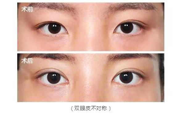 雙眼皮修復(fù)的最佳時(shí)間是什么時(shí)候?價(jià)錢貴不貴?