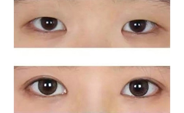 多大年紀(jì)適合做水泡眼矯正術(shù)?效果好不好?