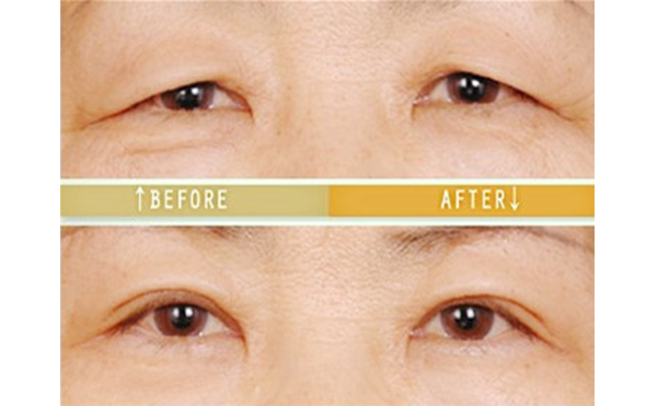 老年人怎么做三角眼矯正?術(shù)后怎么護(hù)理?