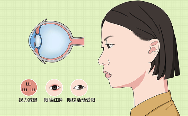 眼球突出什么原因?如何矯正?
