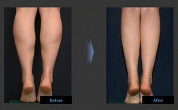 小腿吸脂的原理是什么？