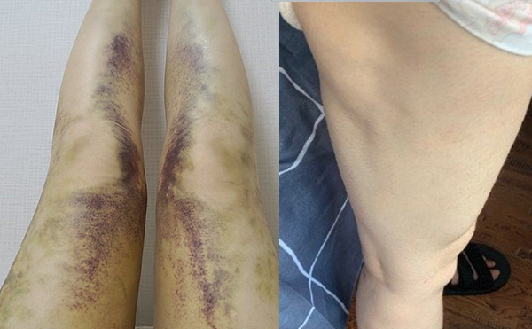 腹部吸脂有什么副作用？