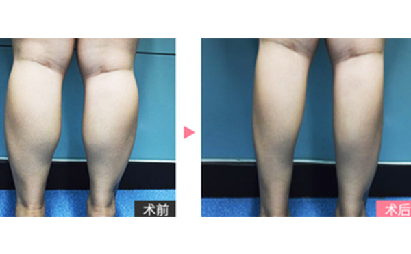 boxo瘦腿有什么優(yōu)勢？