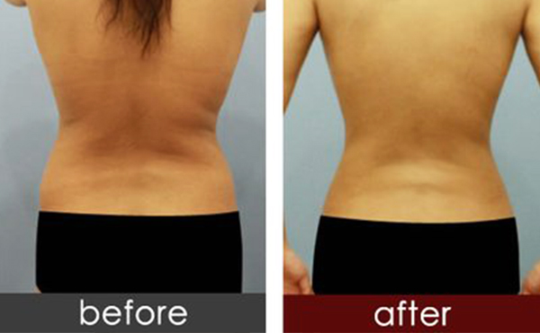 背部吸脂手術(shù)的過(guò)程是什么？