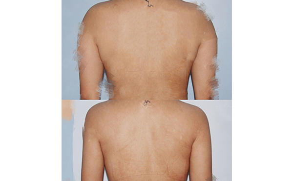 背部吸脂安全嗎？