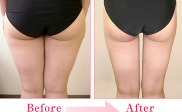 臀部抽脂有什么優(yōu)點？