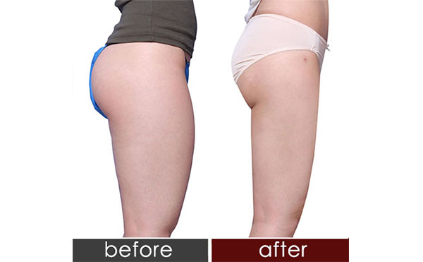 臀部抽脂會(huì)不會(huì)反彈?