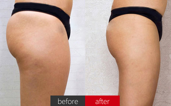 臀部抽脂術(shù)后皮膚會松弛嗎？