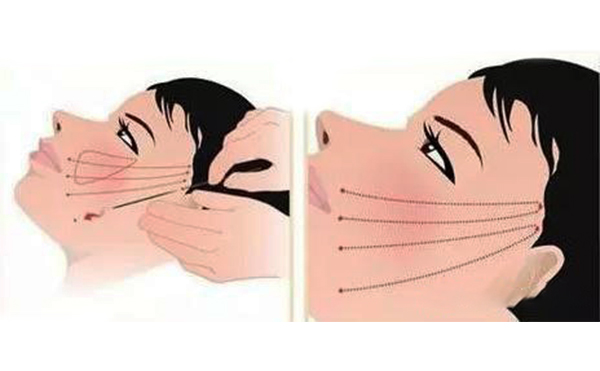 拉皮的原理是什么？