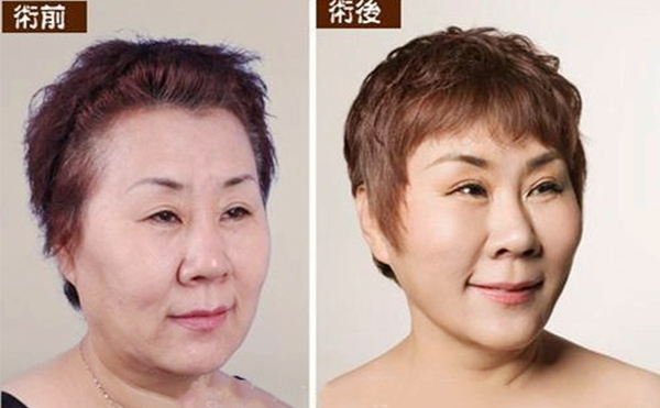 拉皮手術(shù)多久能恢復(fù)自然？