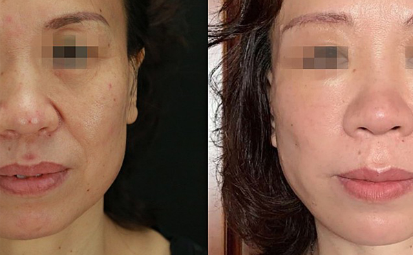 哪些人適合做拉皮手術(shù)？