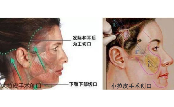 小拉皮和傳統(tǒng)拉皮有什么區(qū)別？