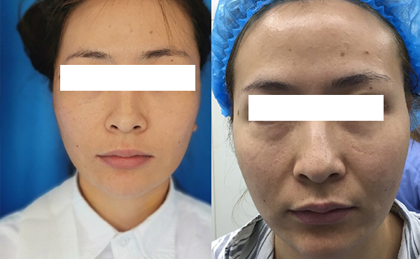 拉皮和線雕哪個效果好？