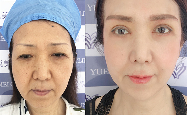 做拉皮與年齡有關嗎？