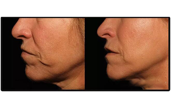 電波拉皮安全嗎？