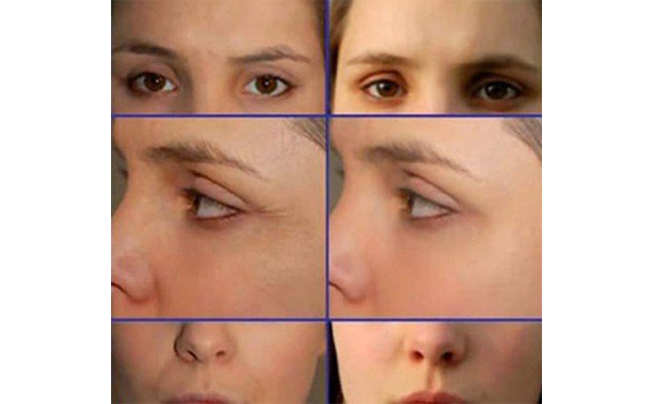 電波拉皮適合哪些人？