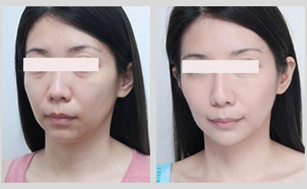 激光除皺是什么原理？