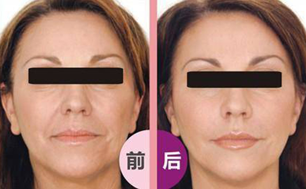 激光除皺會反彈嗎？