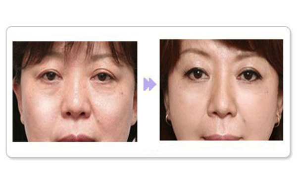 除皺針適合哪個年齡段？